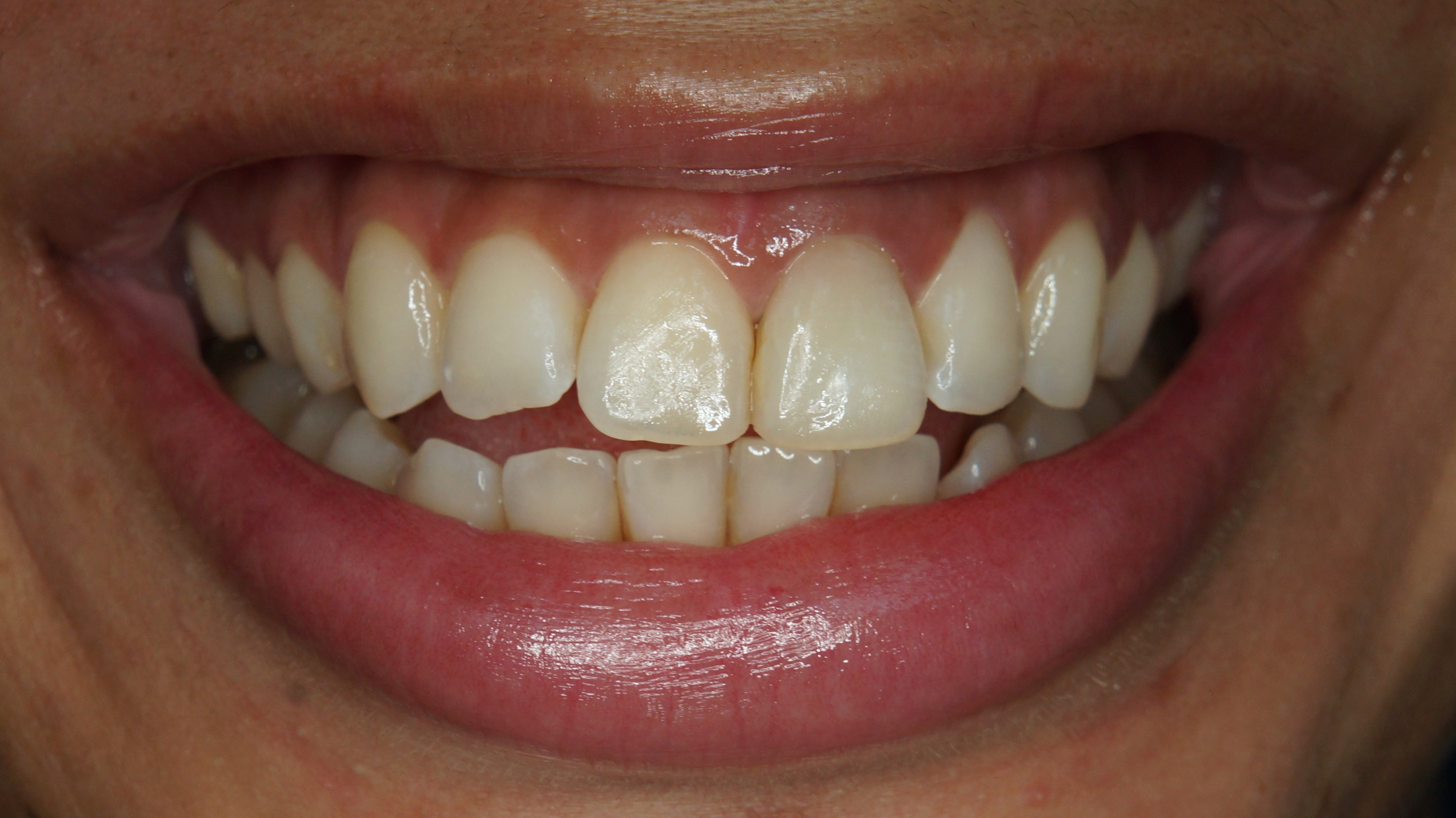 Clareamento Dental - Depois